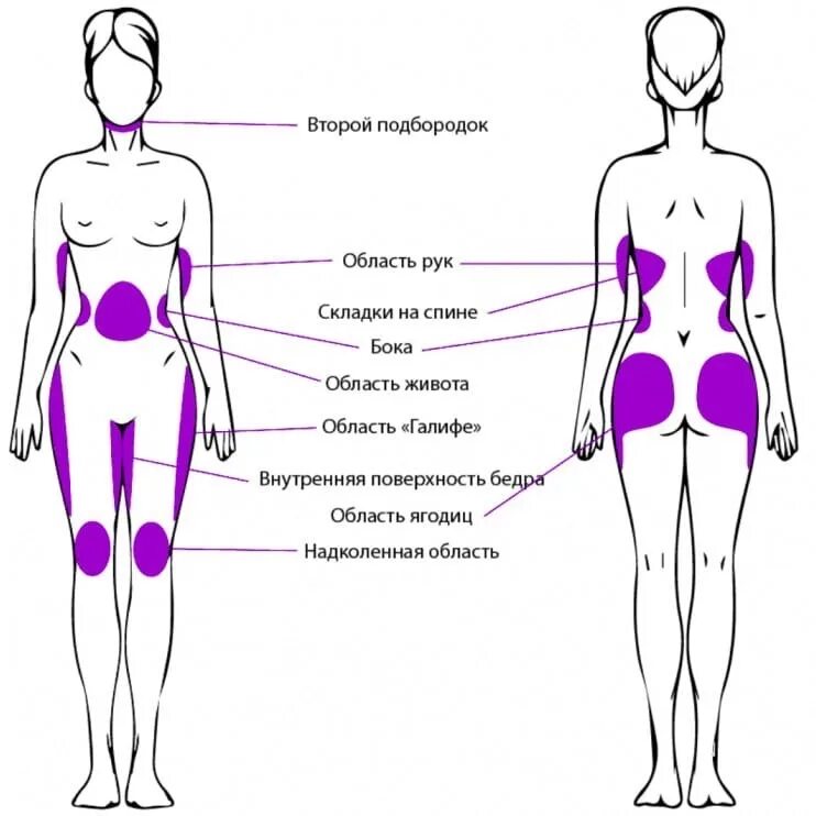 Бока на пояснице. Жировые ловушки. Зоны липосакции на теле. Жировые ловушки на теле.