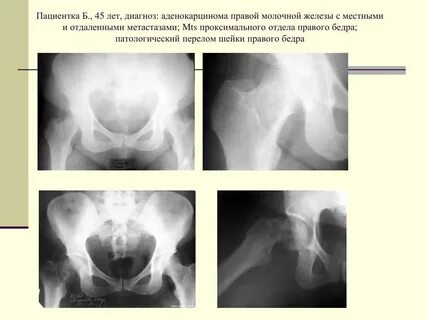 Метастазы в костях при раке молочной железы