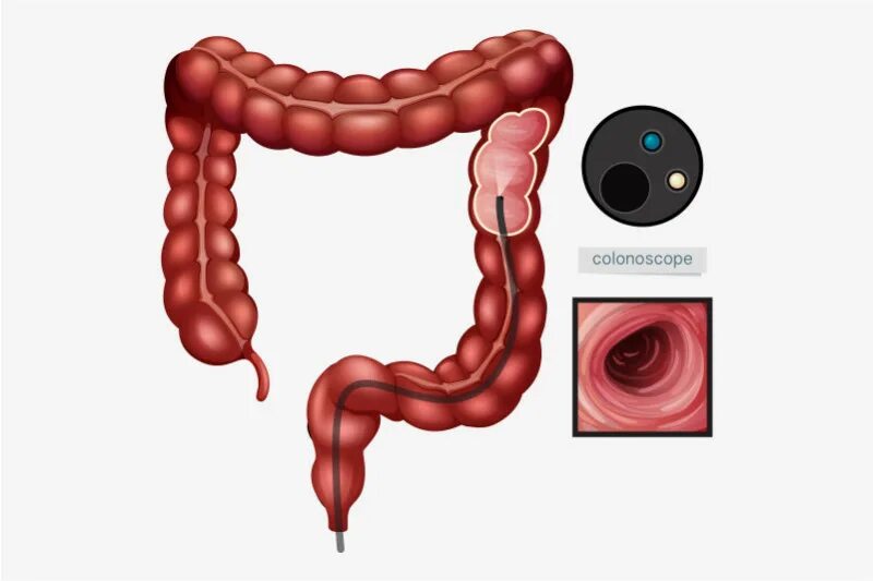 Колоноскопия или фиброколоноскопия. Фиброколоноскопия техника.