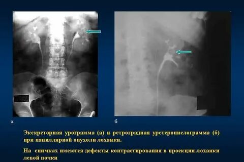 Образование лоханки
