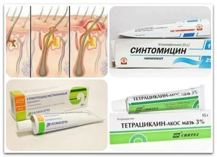 Мазь вытаскивающая гной. Мазь от прыщей на голове у мужчин.