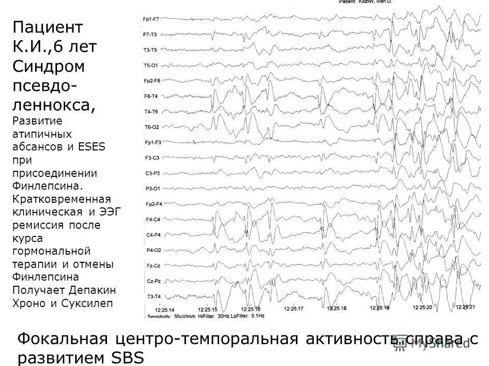 Пароксизмальная ээг. Синдром Леннокса-Гасто ЭЭГ. Абсансная эпилепсия на ЭЭГ. Эпилептические паттерны на ЭЭГ. Паттерн абсанса на ЭЭГ.