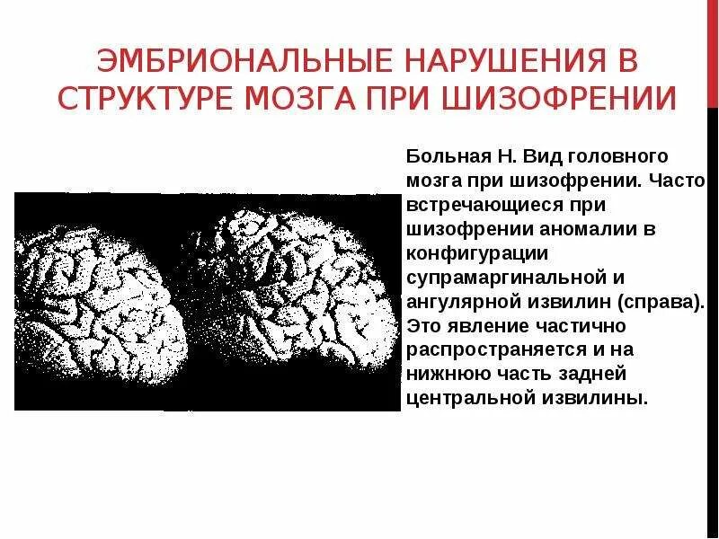 Психические нарушения при мозга. Головной мозг при шизофрении. Мозг человека больного шизофренией. Снимок мозга при шизофрении. Изменения мозга при шизофрении.