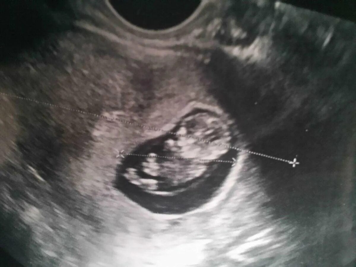 8 недель и 4 дня. Эмбрион на 9 неделе беременности УЗИ. УЗИ 9 недель беременности. Эмбрион на 10 неделе беременности УЗИ. 9 Недель беременности фото плода на УЗИ.