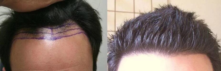 Край роста волос. Край роста волос. Край роста волос. Линия роста волос. Исправление линии роста волос.