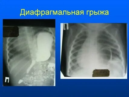 Диафрагмальная грыжа причины