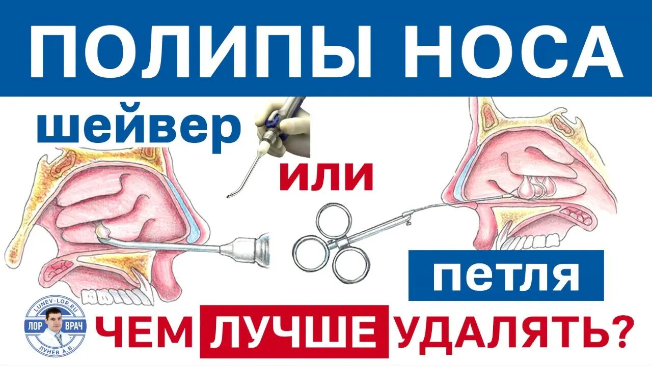 Как выглядит полип после удаления Какие полипы переходят в рак Тулина Инна Андреевна Дзен