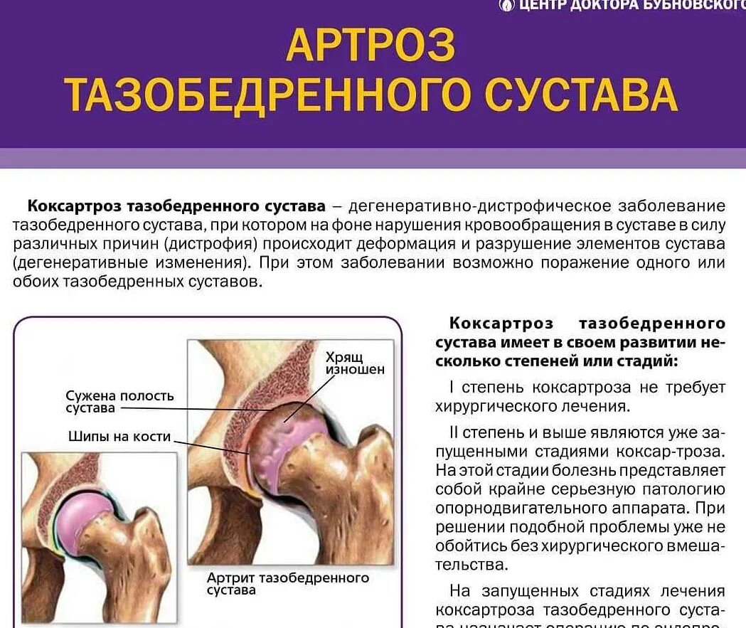 Артроз сколько времени. Артрит коксартроз тазобедренного. артрит бедренного сустава симптомы. коксартроз тазобедренного сустава симптомы. коксартроз клинические симптомы.
