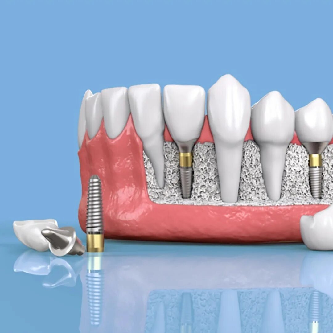 Добрая стоматология цены. Имплантация Osstem. Стоматологические импланты.