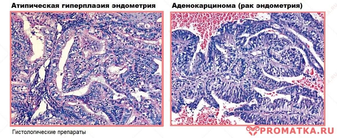 Сложная гиперплазия эндометрия. Атипическая гиперплазия эндометрия гистология. Гиперплазия эндометрия гистология. Атипичная гиперплазия эндометрия матки гистология. Аденоматозный полип гистология.