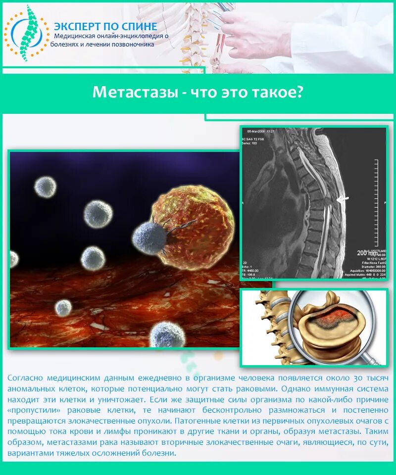 Какой рак метастазирует. Метастазирующие опухоли.