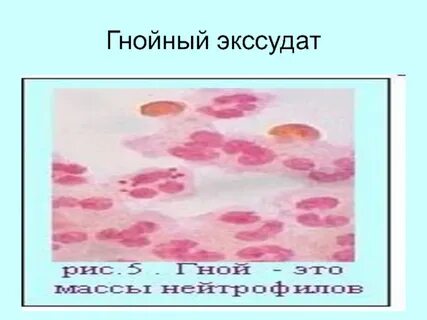 Экссудат это