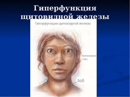 Глаза при щитовидной железе