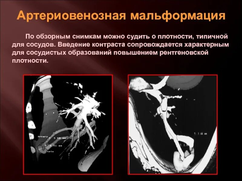 Мальформация. Артериовенозная мальформация ангиография. арерио венозная мальформация. сосудистые врожденные мальформации. артериовенозная дисплазия.