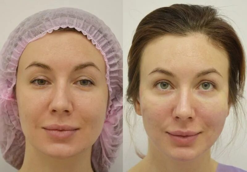 до и после ношения брек тов. прошел месяц после установки. нити аптос экселанс визаж. лифтинг лица нитями aptos excellence visage. нитевая подтяжка лба.