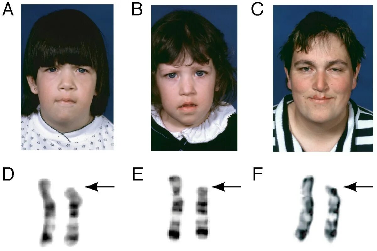 Синдром де груши кариотип. Синдром Эдвардса (трисомия 18). Синдром Эдвардса (трисомия по 18 паре хромосом). Синдром Тернера (моносомия х хромосомы). Трипло х