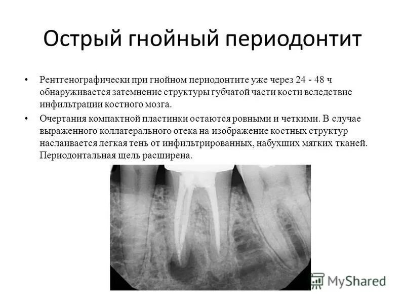 Фиброзный периодонтит. Описание рентгена зуба с периодонтитом. Острый Гнойный апикальный периодонтит. Апикальный серозный периодонтит. Хронический фиброзный периодонтит рентген.