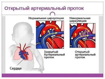 Врожденный порок артериальный проток