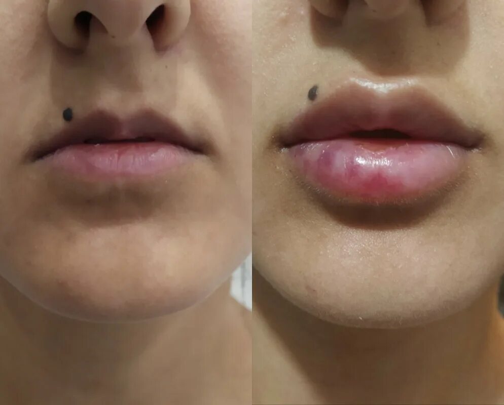 Увеличение губ усы гиалуроновые. Контурная пластика губ бантиком. Техника увеличения губ бантиком.