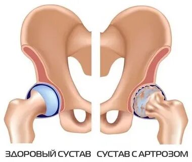 Артроз тазобедренных суставов 1 ст
