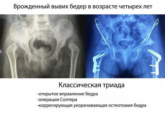 Подвывих после операции. Врожденный вывих бедра операция. врожденный подвывих бедра.