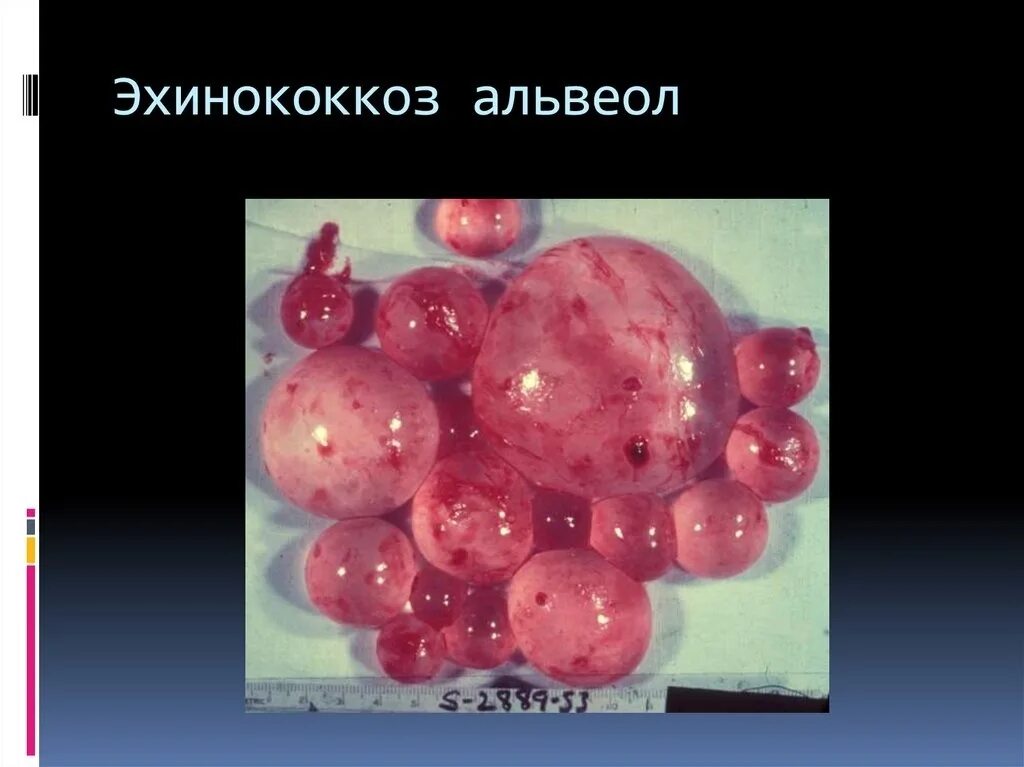 Эхинококки симптомы у людей лечение. Гидатидный эхинококкоз печени. Клинические проявления эхинококкоза.