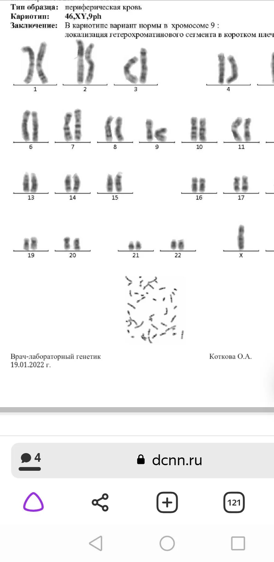 кариотип 46 xy. кариотип плода 46 хх. кариотип 46 xy. 46,xy нормальный мужской кариотип. кариотип 46 xy.