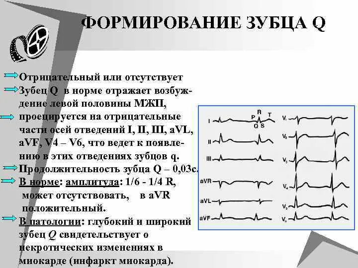 Изменение зубца q. Глубокий зубец q в 3 отведении на ЭКГ. Признаки патологического зубца q. Отрицательный зубец q в 3 отведении и AVF. Формирование зубца q.