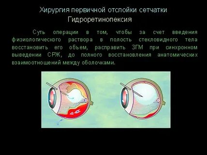 Виды отслойки сетчатки