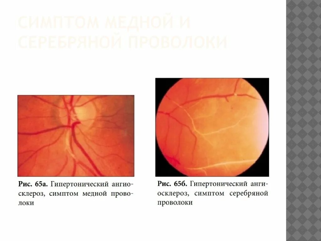 Гипертоническая ретинопатия глазное дно. Симптомы Салюса — Гунна, Гвиста, «медной и серебряной проволоки».. Симптом медной проволоки глазное дно. Гипертоническая ретинопатия Салюс. Сетчатки по гипертоническому типу
