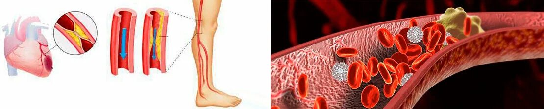 Тромбозы и эмболии периферических артерий. Паразитарная эмболия эмболия. Эмболия периферических сосудов. Тромбоз и эмболия и атеросклероз.