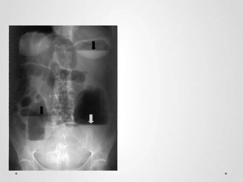 Непроходимость Толстого кишечника рентгенография. Непроходимость толстой кишки рентген. Раздутые петли Толстого кишечника рентген. Кишечная непроходимость толстой кишки рентген. Расширение петель кишечника