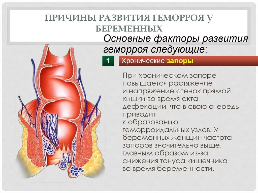 Геморрой при беременности