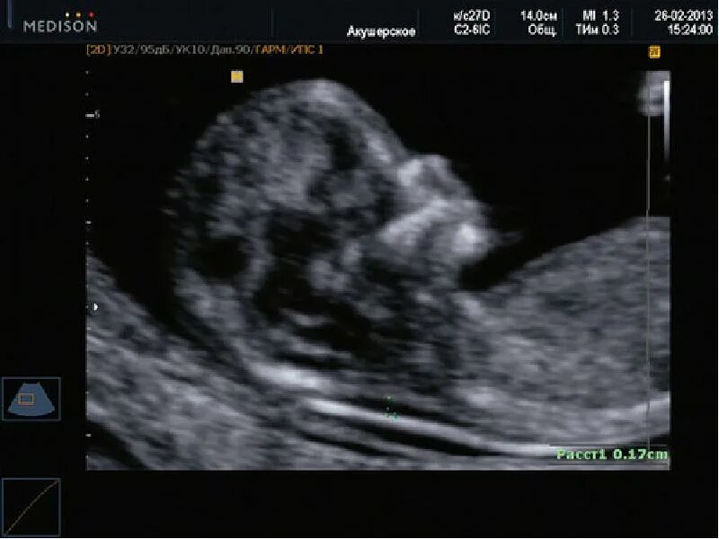 Носовая кость визуализируется. Узи 13 недель беременности носовая кость. Узи 13 недель беременности носовая кость. Носовая кость 1 скрининг. Узи 20 недель беременности носовая кость.