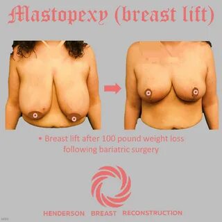 Breast lift (mastopexy) .