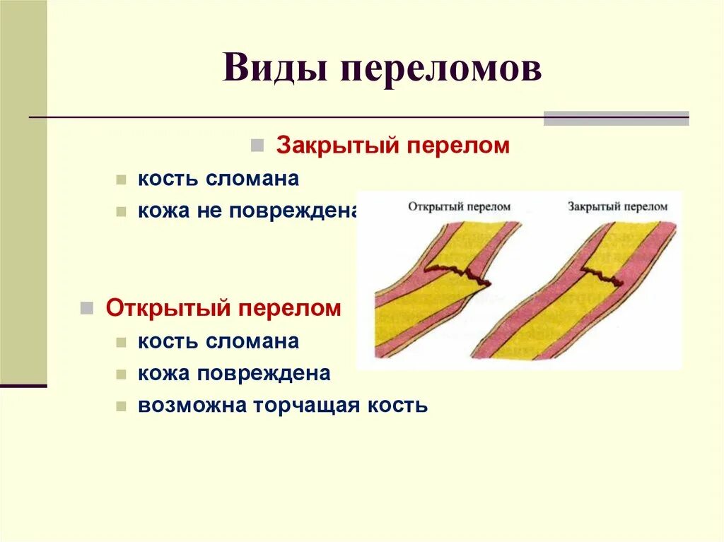 Типы закрытых переломов. Переломы, их виды. Основные признаки переломов.. Какие бывают переломы костей. Назовите виды переломов. Каковы их основные признаки?. Типы переломов костей конечностей.