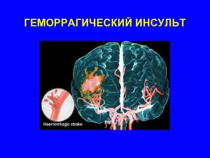 Инсульт геморрагический правая. Подострый геморрагический инсульт. Полушарный ишемический инсульт. Геморрагический инсульт клиника. Геморрагический инсульт кровоизлияние.