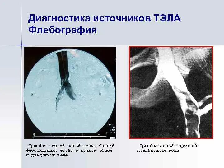 Тромбоз нижней полой вены на кт. Тромб нижней полой вены кт. Тромбоэмболия легочной артерии диагностика. Тромбоэмболия артерии дифференциальная диагностика. Тромбоза вен печени