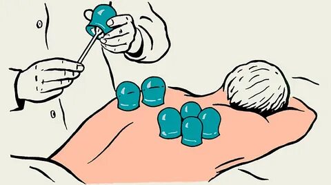 На какое время ставят банки на спину