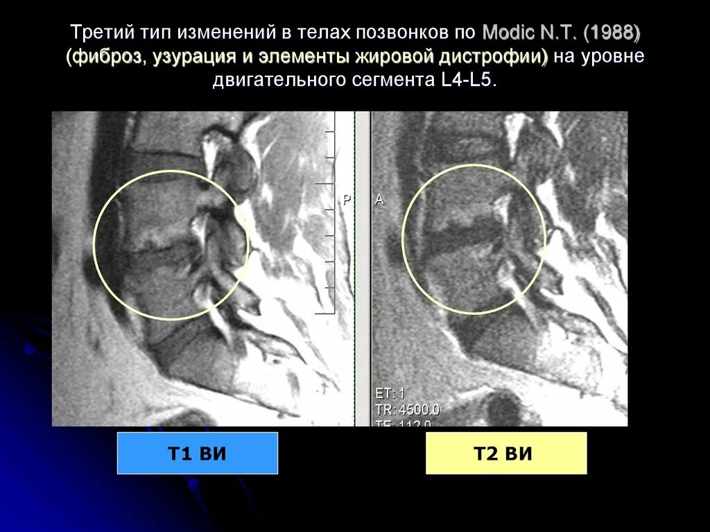 Изменение по типу modic 1