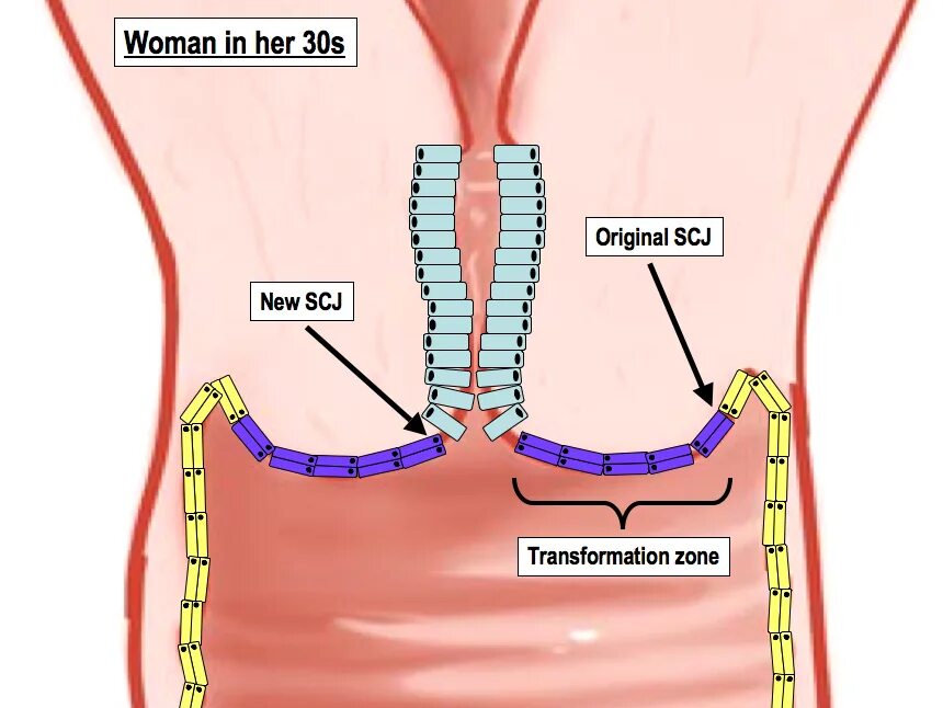 Зона трансформации шейки матки 1. Шейка матки зона трансформации. Врожденная зона трансформации шейки матки. Зона трансформации в матке. Эндоцервикс цилиндрический
