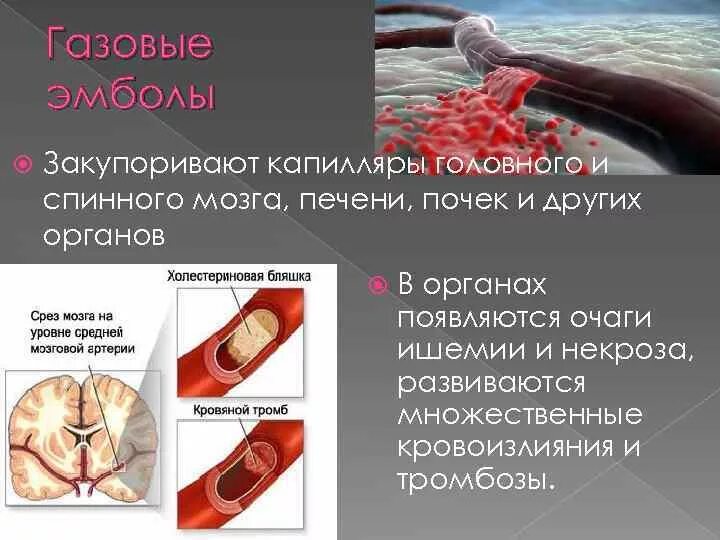 Эмболия тромбы. Патологии сосудов тромбоз эмболия. Газовая эмболия сосудов.