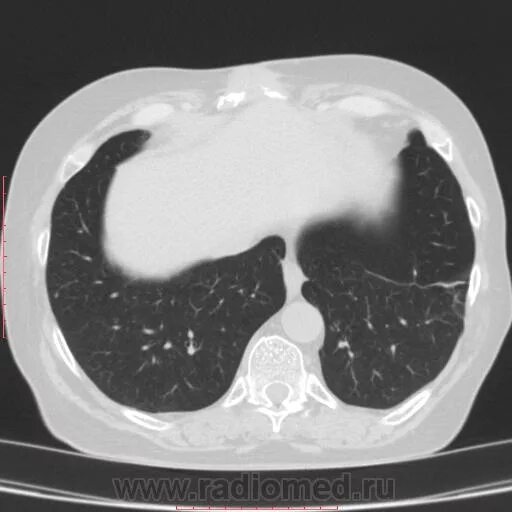 Кт легких ростов цены. СКТ снимок легких норма. Снимок кт легких. Снимки кт легких. Здоровые легкие на кт.