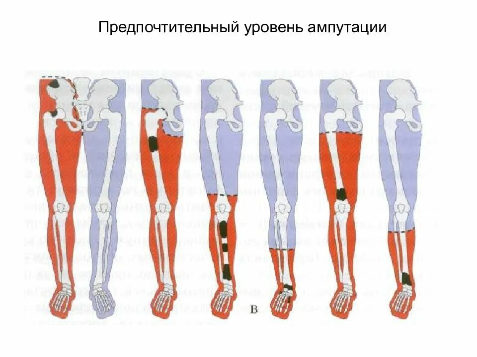 Уровни ампутации конечностей. Классификация ампутаций нижней конечности. Уровни ампутации нижней конечности. Однолоскутная ампутация голени. Ампутация верхней трети голени.