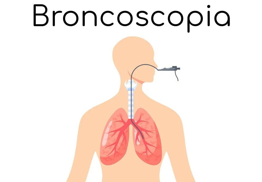 Сердце кашель мокрота. Дыхательный бронхоскоп. Бронхоскопия при бронхиальной астме. Бронхоскопия кровохарканье.