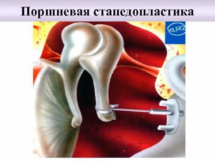 Отосклероз стапедопластика. Операция при отосклерозе уха. Тефлоновый протез стапедопластика. Операция стапедопластика при отосклерозе. Отосклероз уха операция