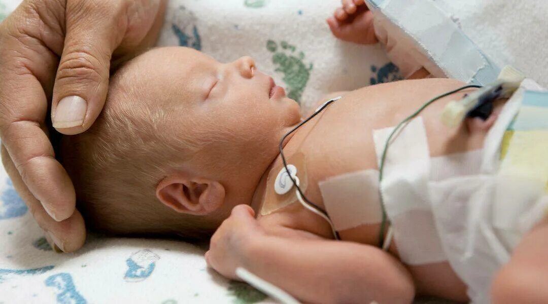 Поздний неонатальный сепсис новорожденных. Кожа недоношенного ребенка. Клинические симптомы сепсиса у новорожденных детей.