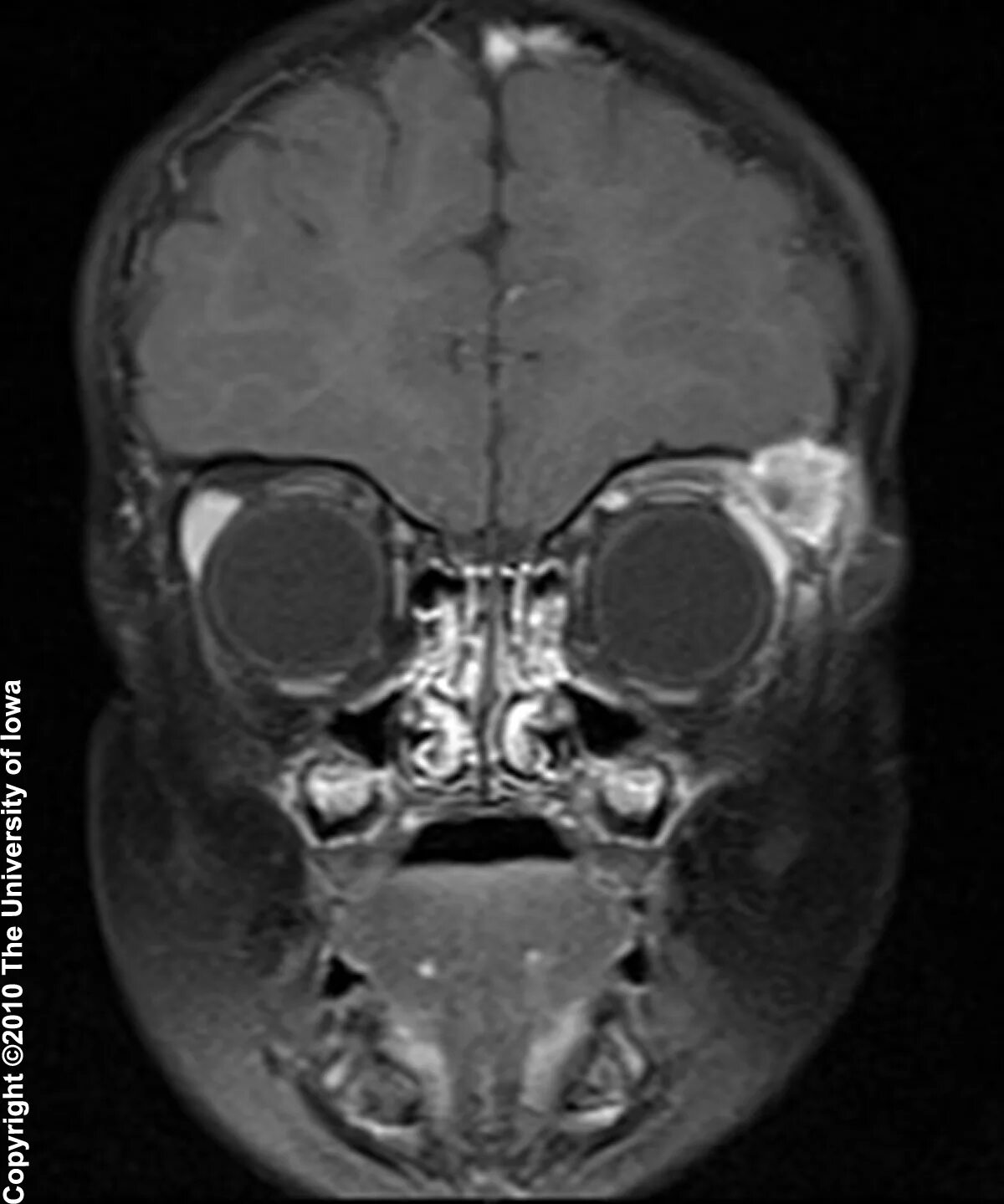 опухоль головного мозга деформация черепа. кт костей лицевого отдела черепа. остеопороз костей черепа на кт. остеопороз костей черепа на кт. мрт костей черепа.