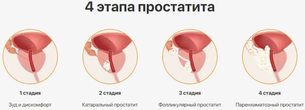 Степени простатита