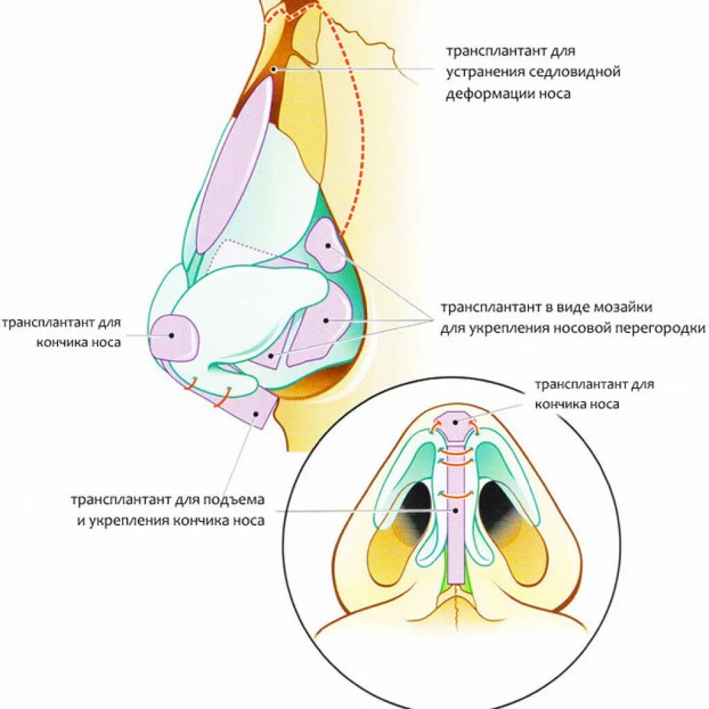 Трансплантант. Устранение седловидной деформации носа. Схема открытой ринопластики. Закрытая ринопластика схема.